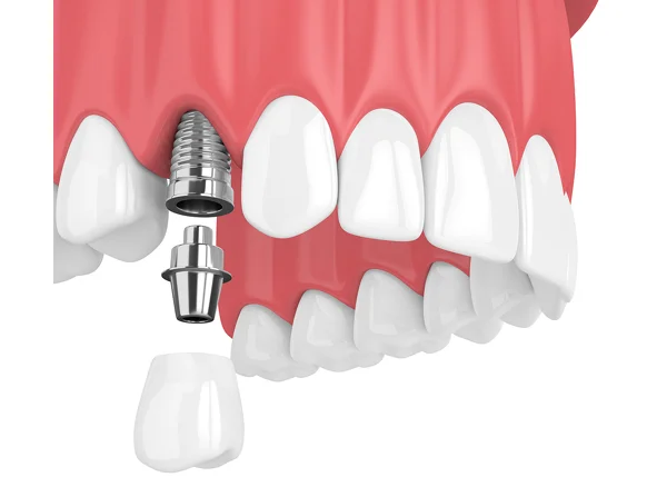 Dental treatment image